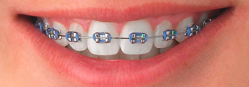 Ortodoncia (Brackets)
