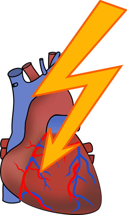 Arrhythmia