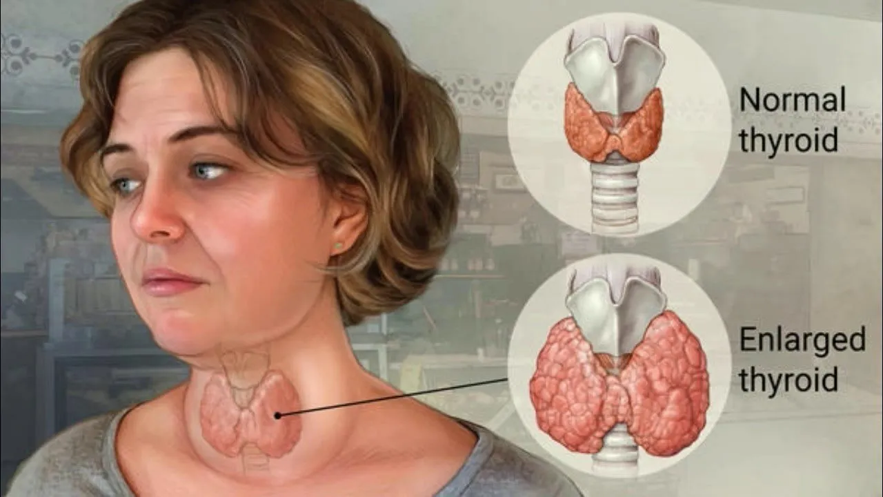 درباره‌ی گواتر چه می‌دانید؟