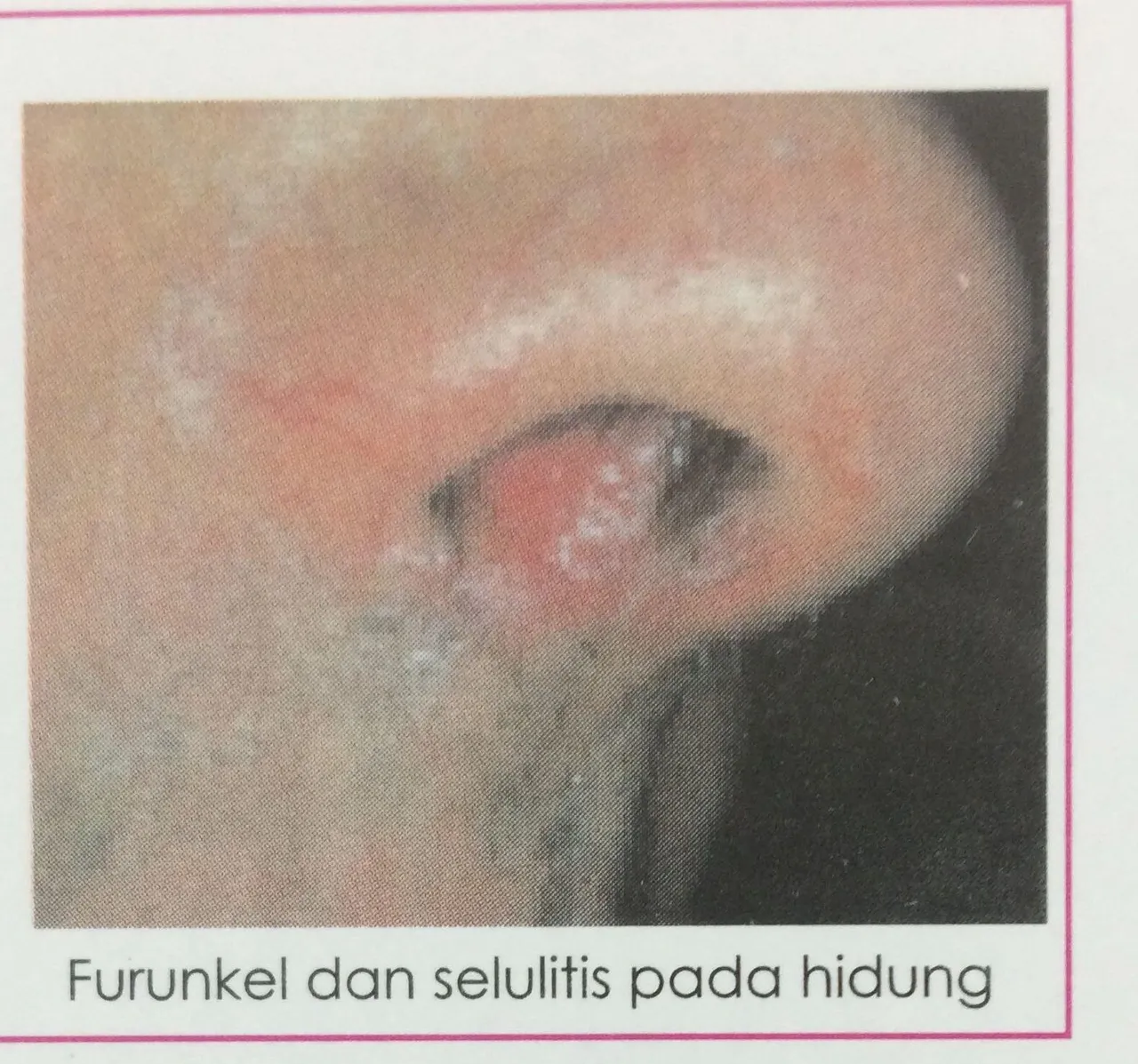 INFEKSI PADA HIDUNG LUAR