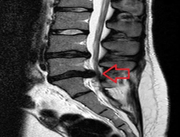 Sciatica MRI