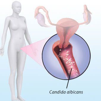 VAGINAL YEAST INFECTION