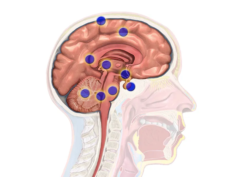 Brain_Cancer_Regions.png