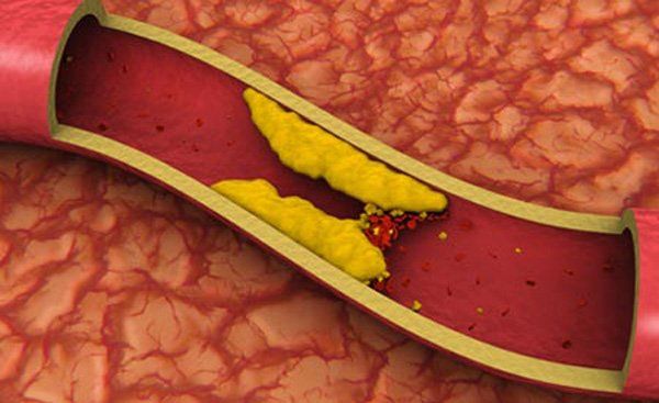 Zum Top-Ernährungsthema Cholesterin ist schon alles gesagt – so schien es bis vor kurzem.