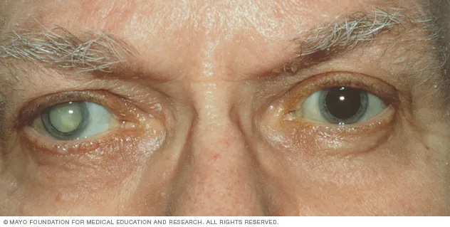 ds00050_im01228_vi7_cataractthu_jpg.jpg