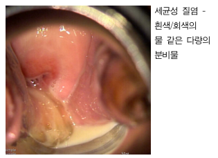 세균성 질염은 흰색/회색의 물같은 다량의 분비물을 특징으로 한다
