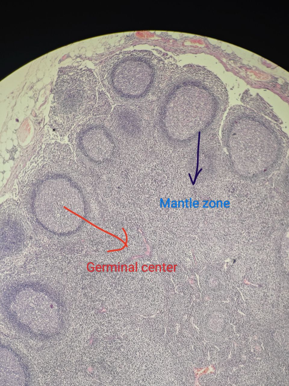 Do you know what is metastasis? And how a metastatic lymph node looks like?