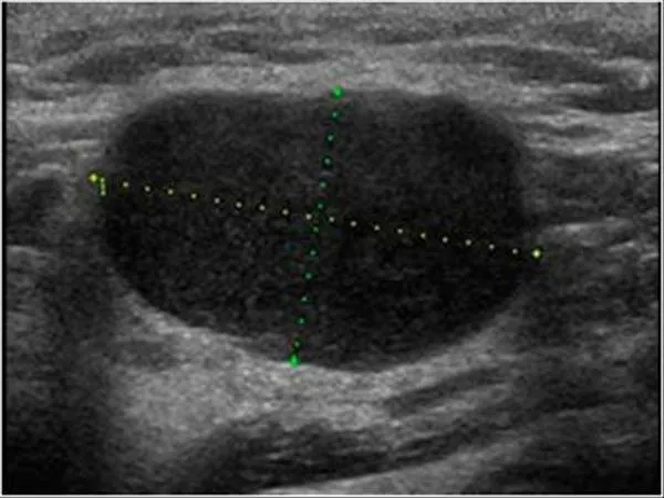 Ultrasound of a lymph node