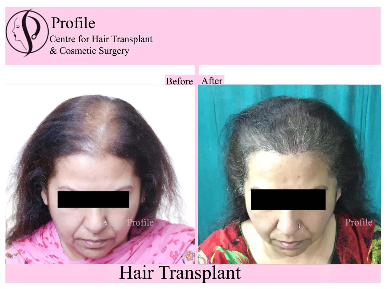Hair Transplant