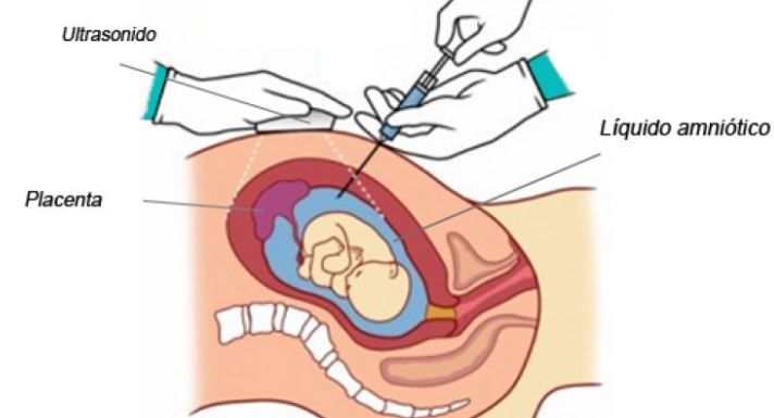 amniocentesis.jpg