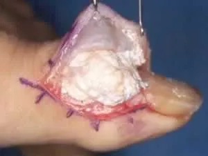 gout-surgery.jpg