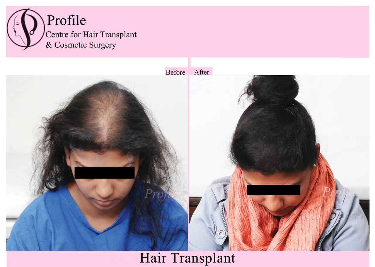 hair transplant