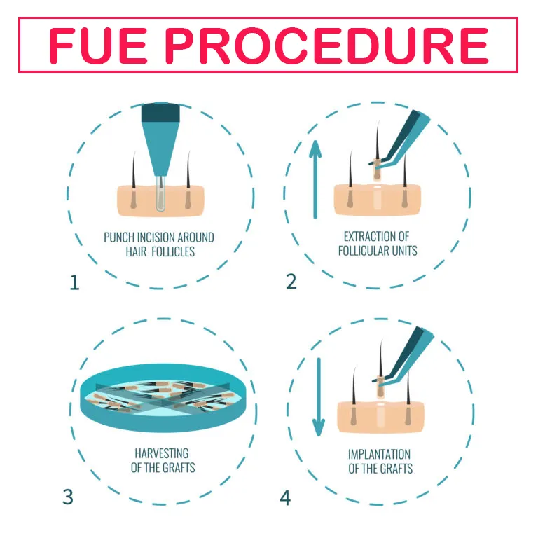FUE hair Transplant
