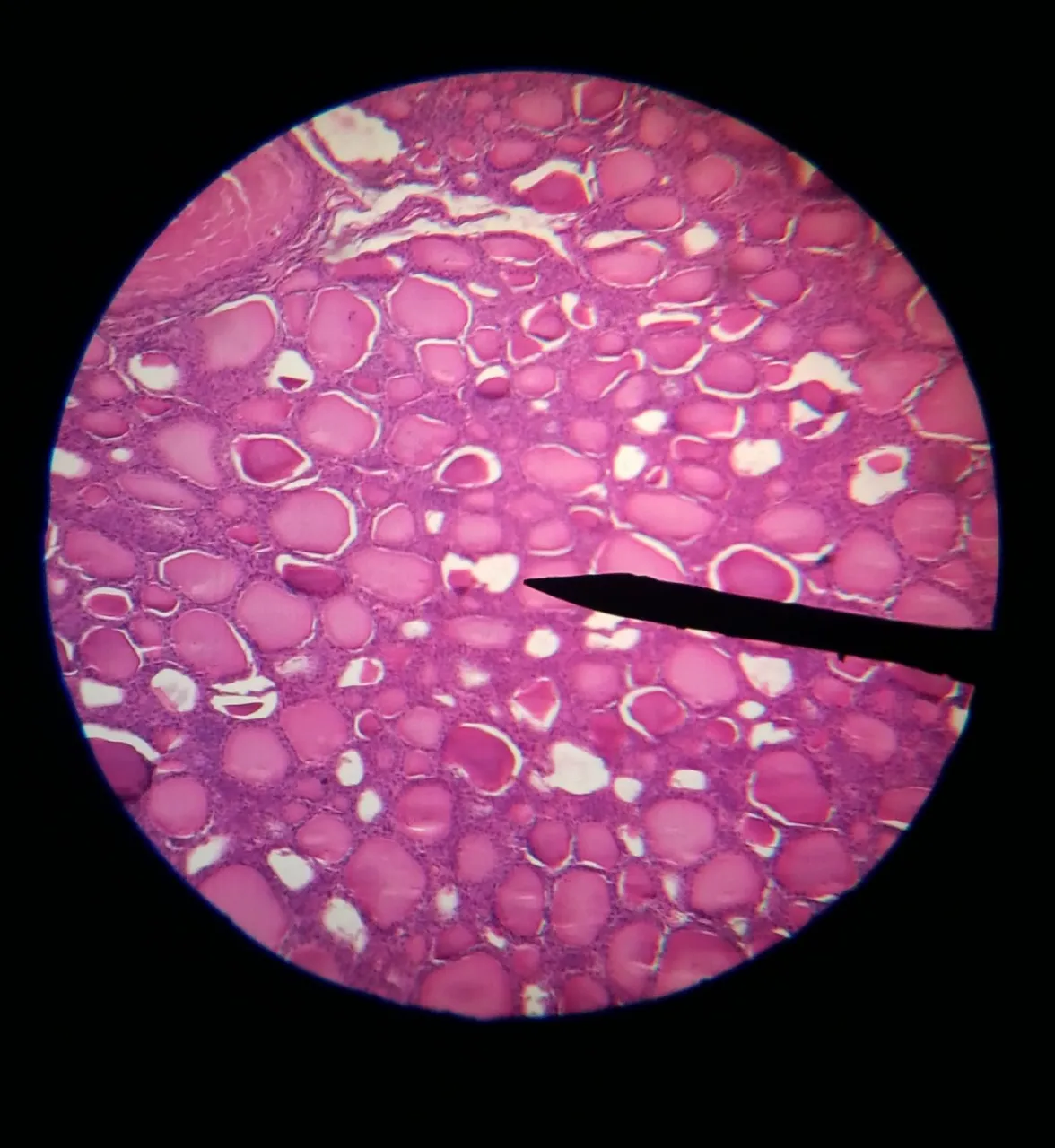 Thyroid.jpg
